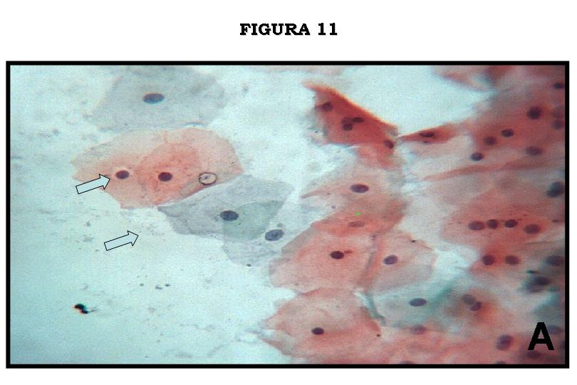 Figura 11. Fotomicrografia mostrando critrios citolgicos inflamatrios (fundo 